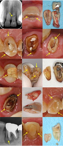 歯内療法後の補綴治療