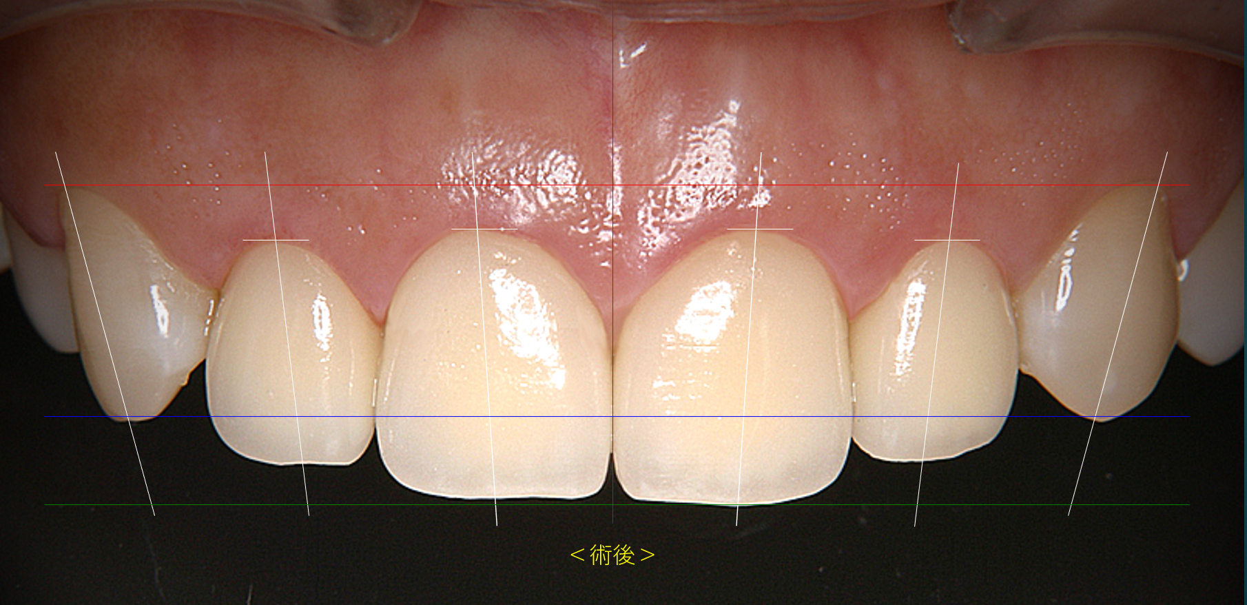 歯茎との調和を考慮した審美歯科