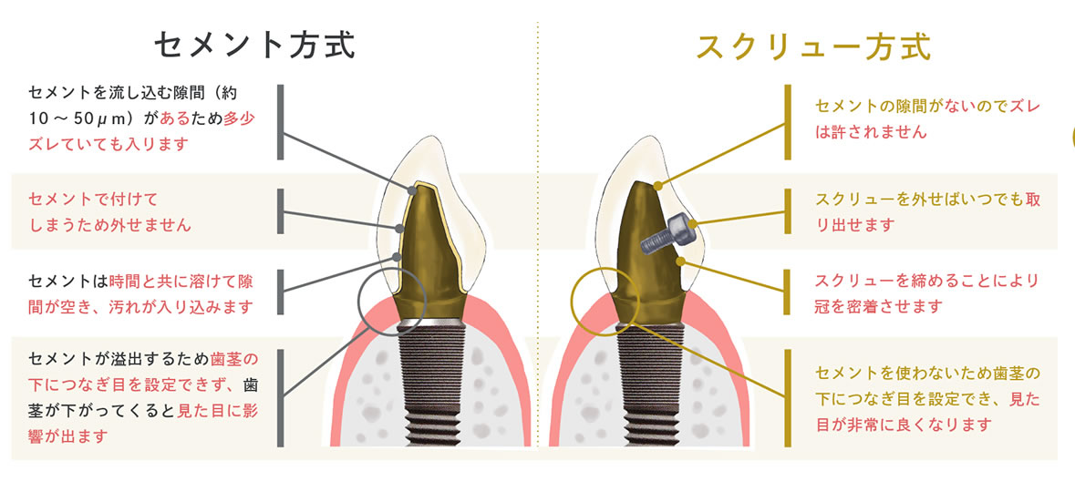 舌側サイドスクリュー