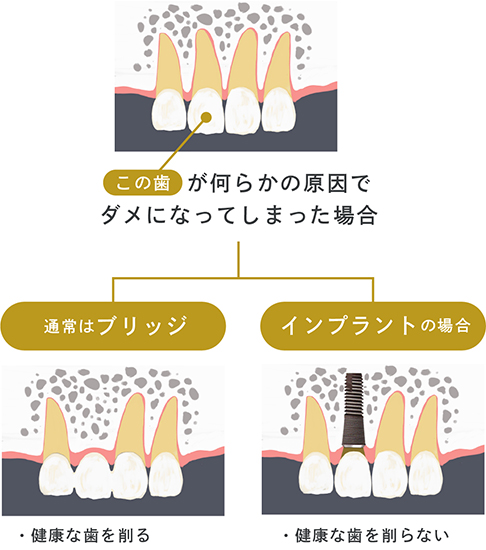 ブリッジとの比較