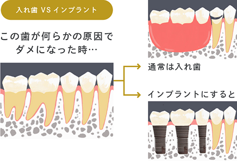 入れ歯との比較