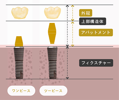 インプラントの構造