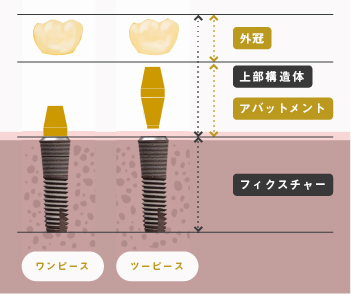 インプラントの構造