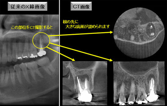 従来からのX線撮影とCT撮影の違い