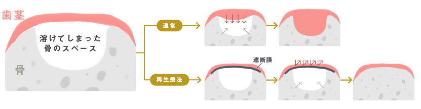 再生療法とは