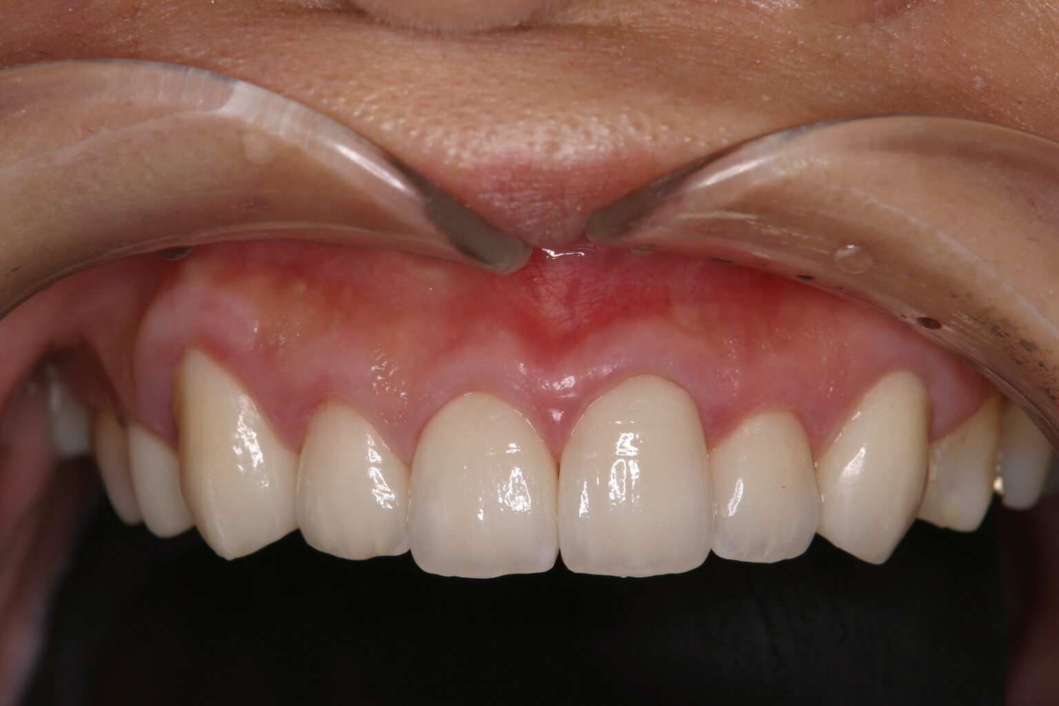 歯冠修復（審美歯科）症例25
