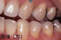 歯冠修復症例7