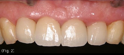 歯冠修復（審美歯科）症例19