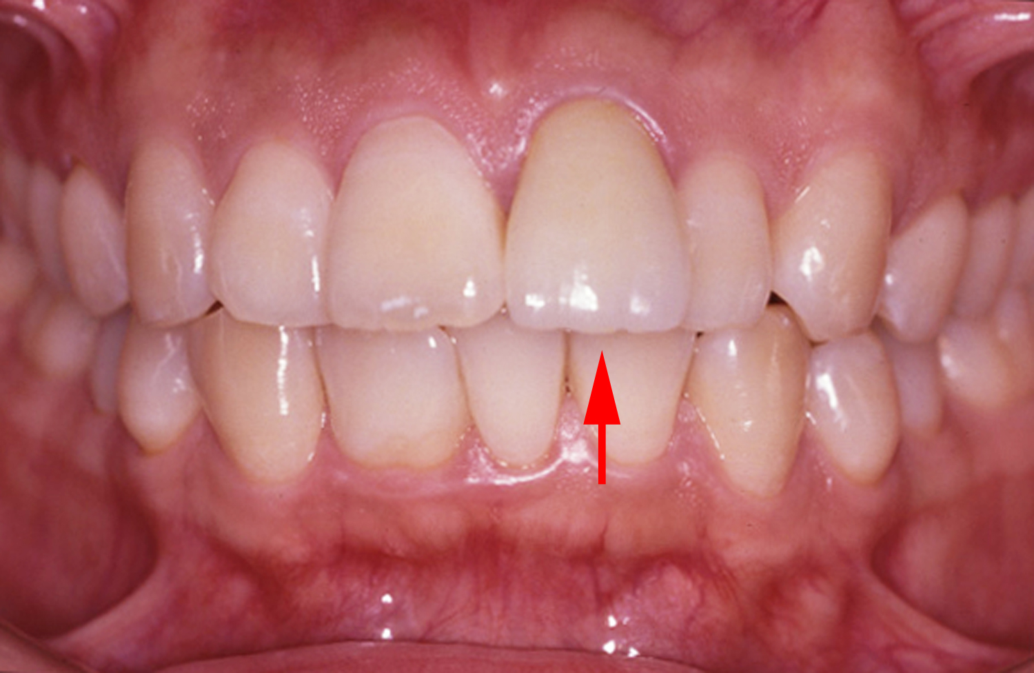 歯冠修復（審美歯科）症例1