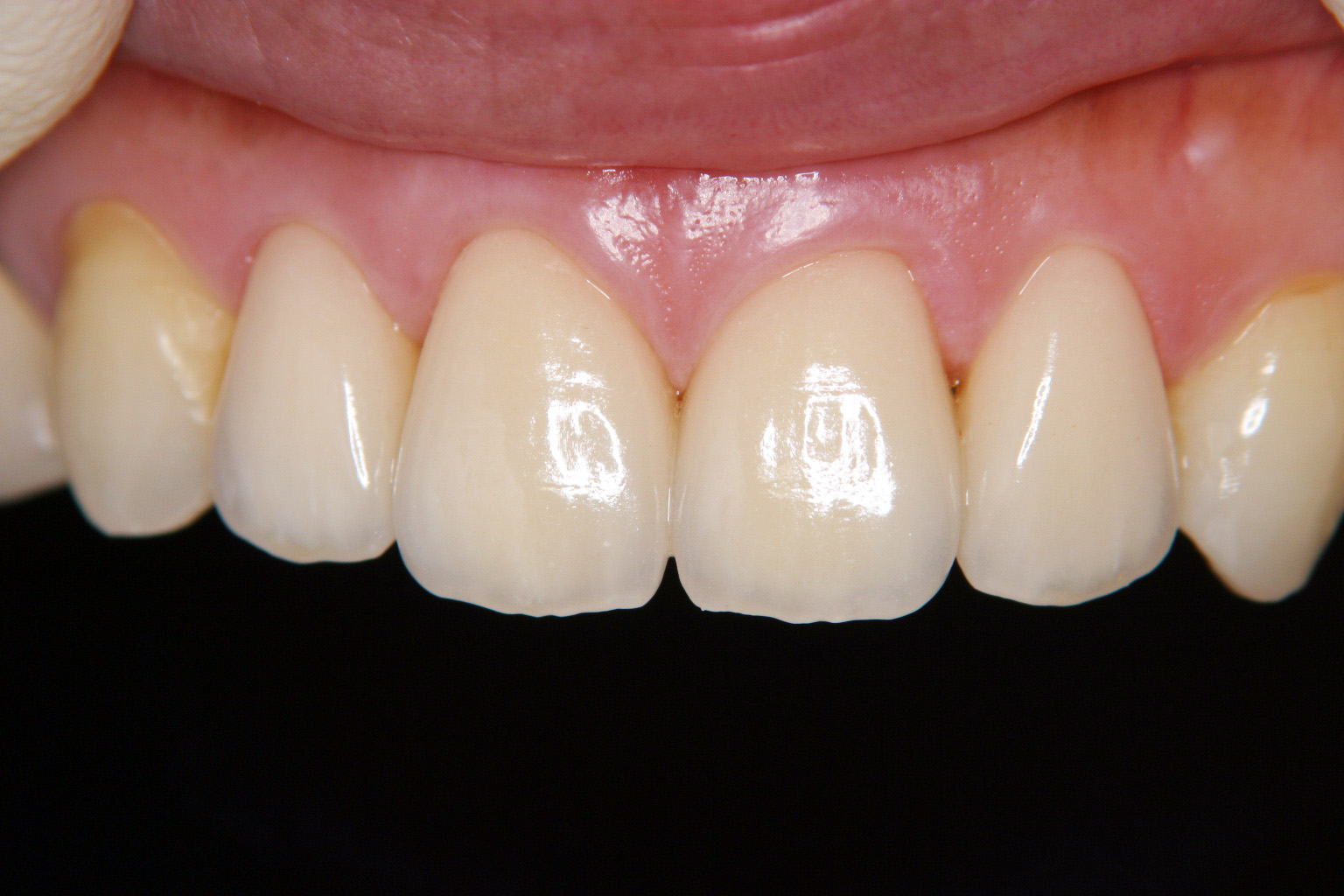 歯冠修復（審美歯科）症例10