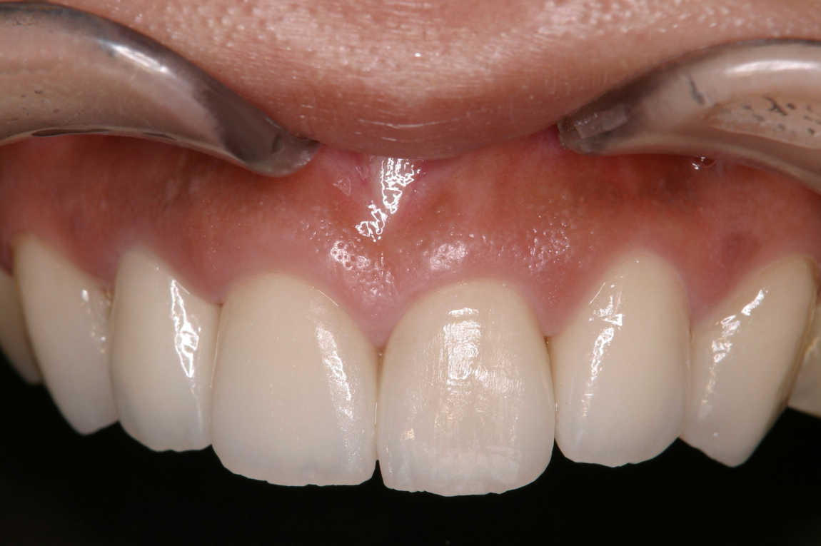 歯冠修復（審美歯科）症例24