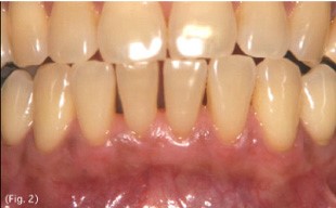 歯周形成外科症例3（メラニン除去）