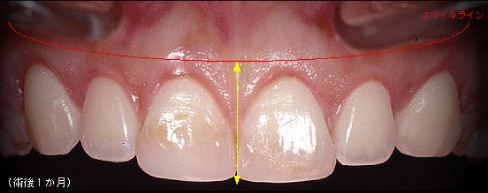 歯周形成外科症例２（ガミースマイルの改善）