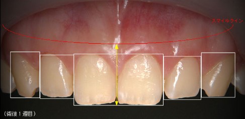 歯周形成外科症例１（ガミースマイルの改善）