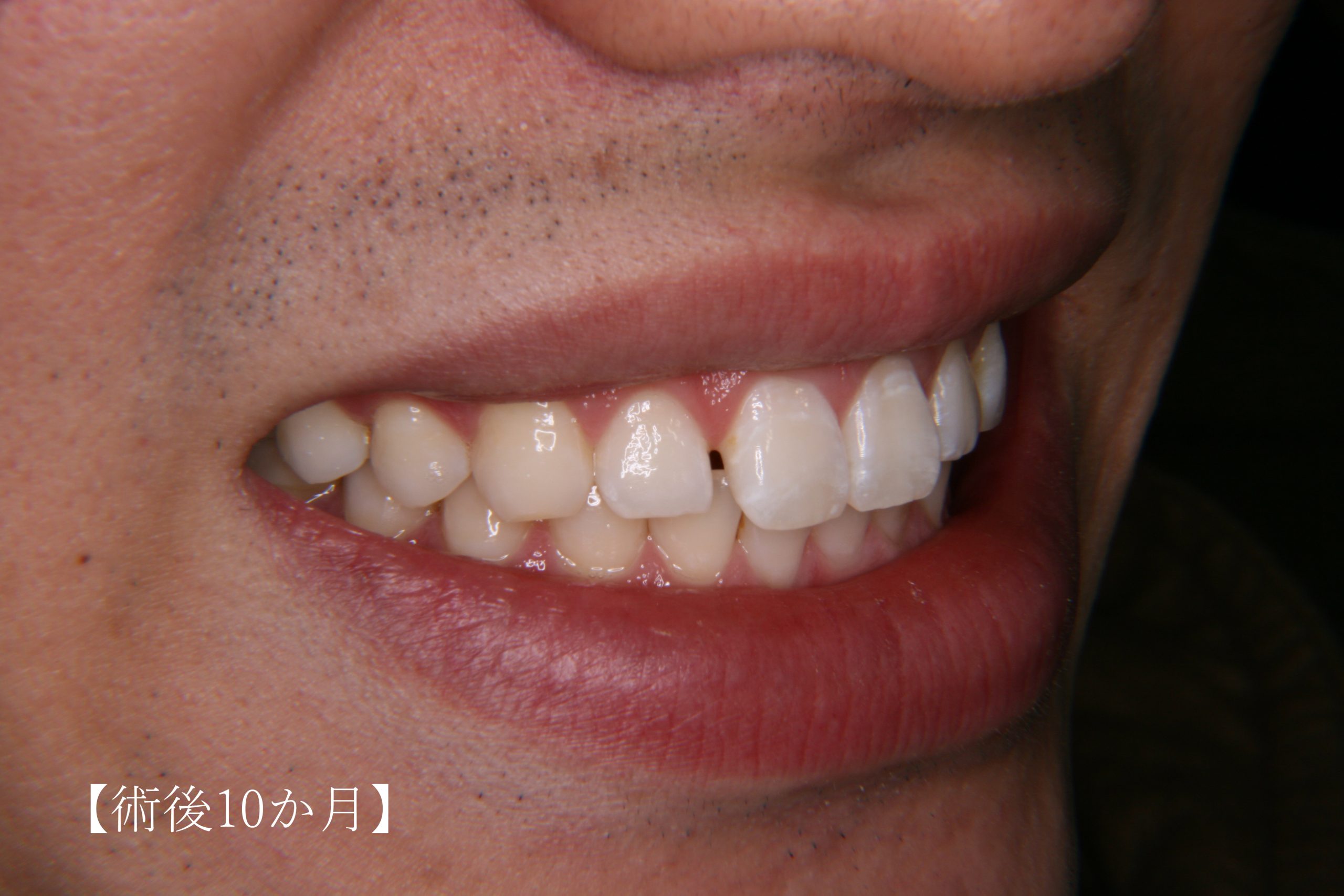歯周形成外科症例7（ガミースマイルの改善）