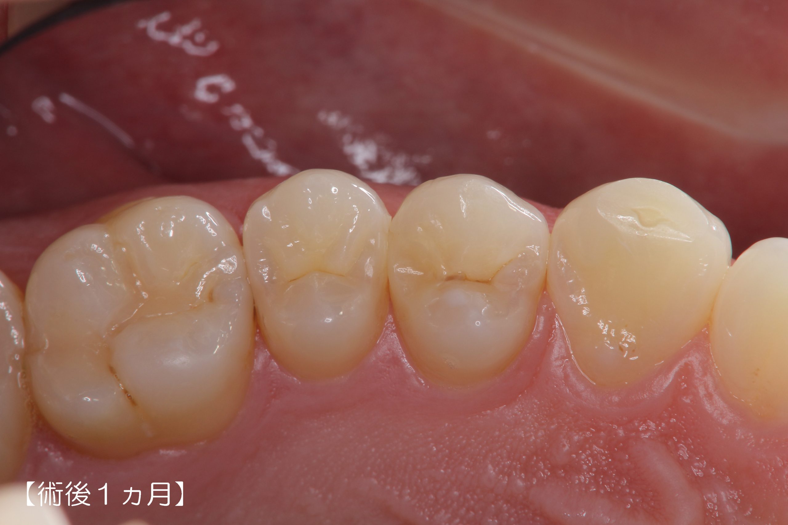 歯冠修復（う蝕治療）症例28