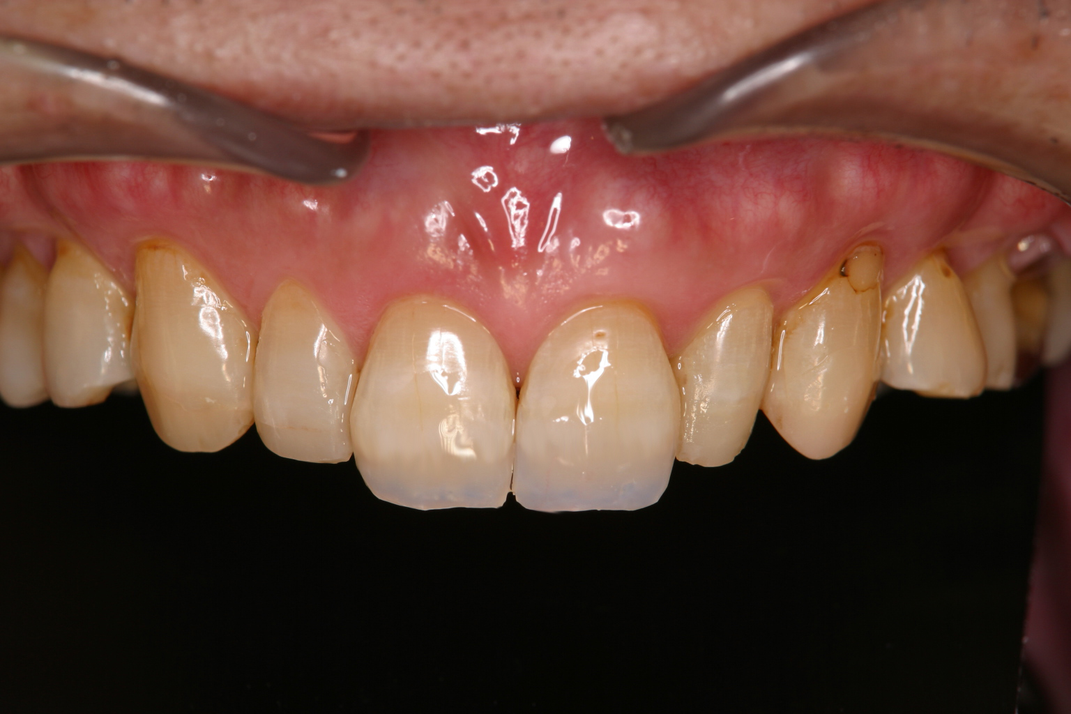 歯冠修復（審美歯科）症例26