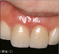 歯冠修復（審美歯科）症例17