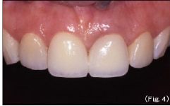 歯冠修復（審美歯科）症例9