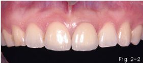 歯冠修復（審美歯科）症例14