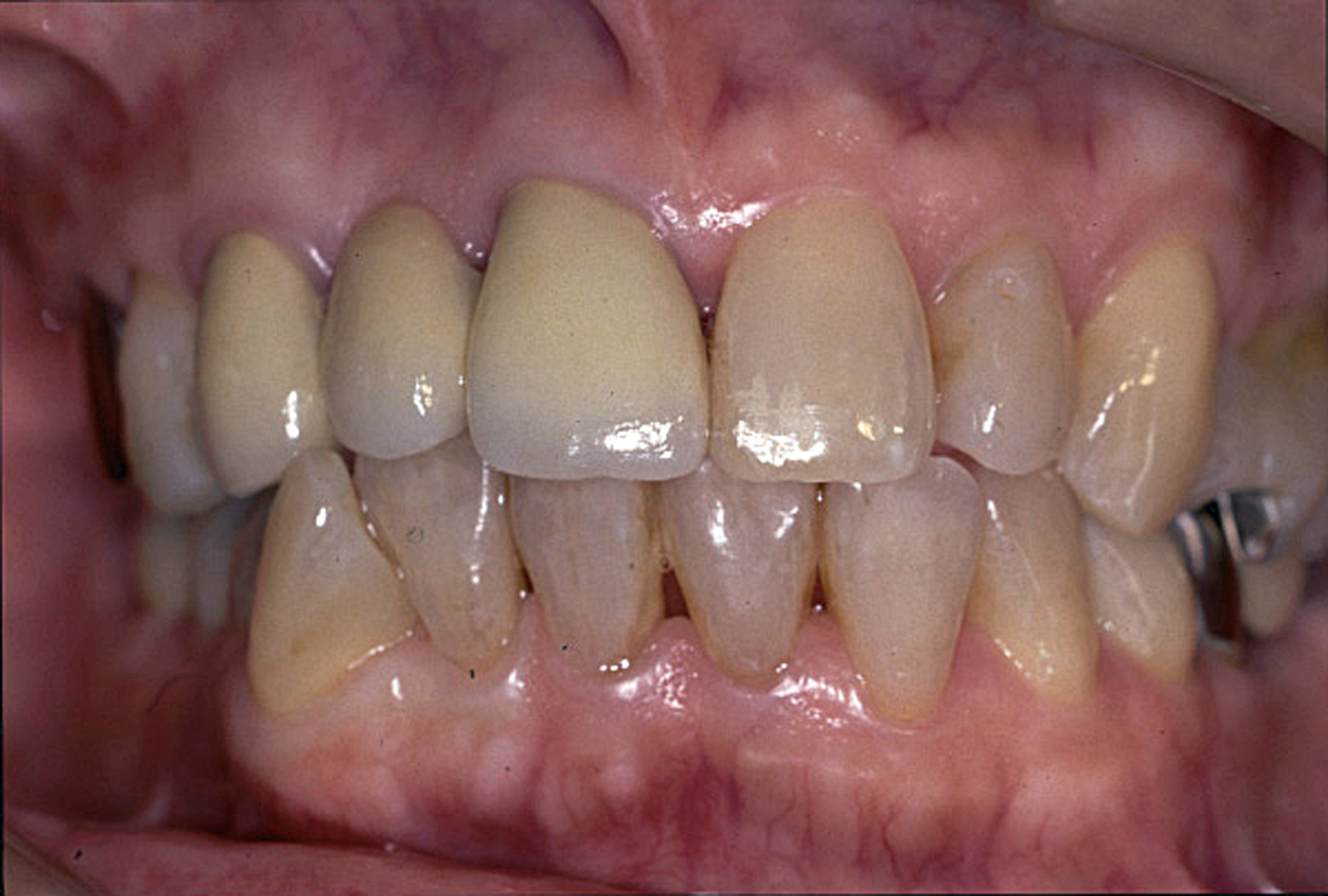 歯冠修復（審美歯科）症例4