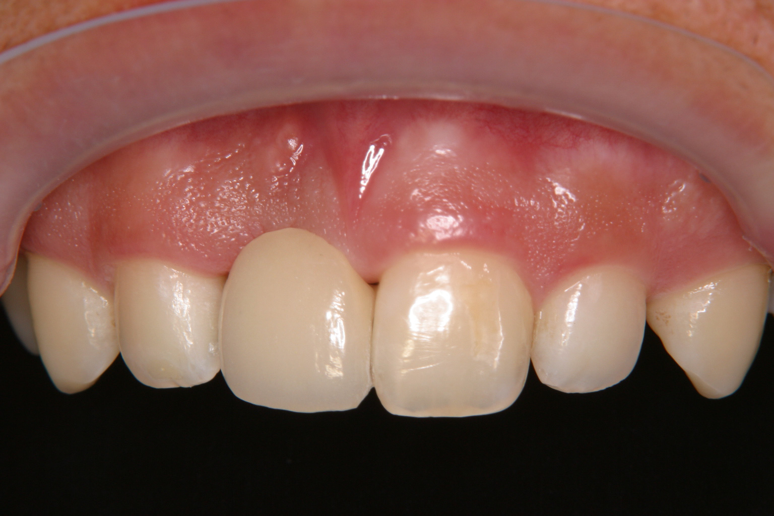 歯冠修復（審美歯科）症例16