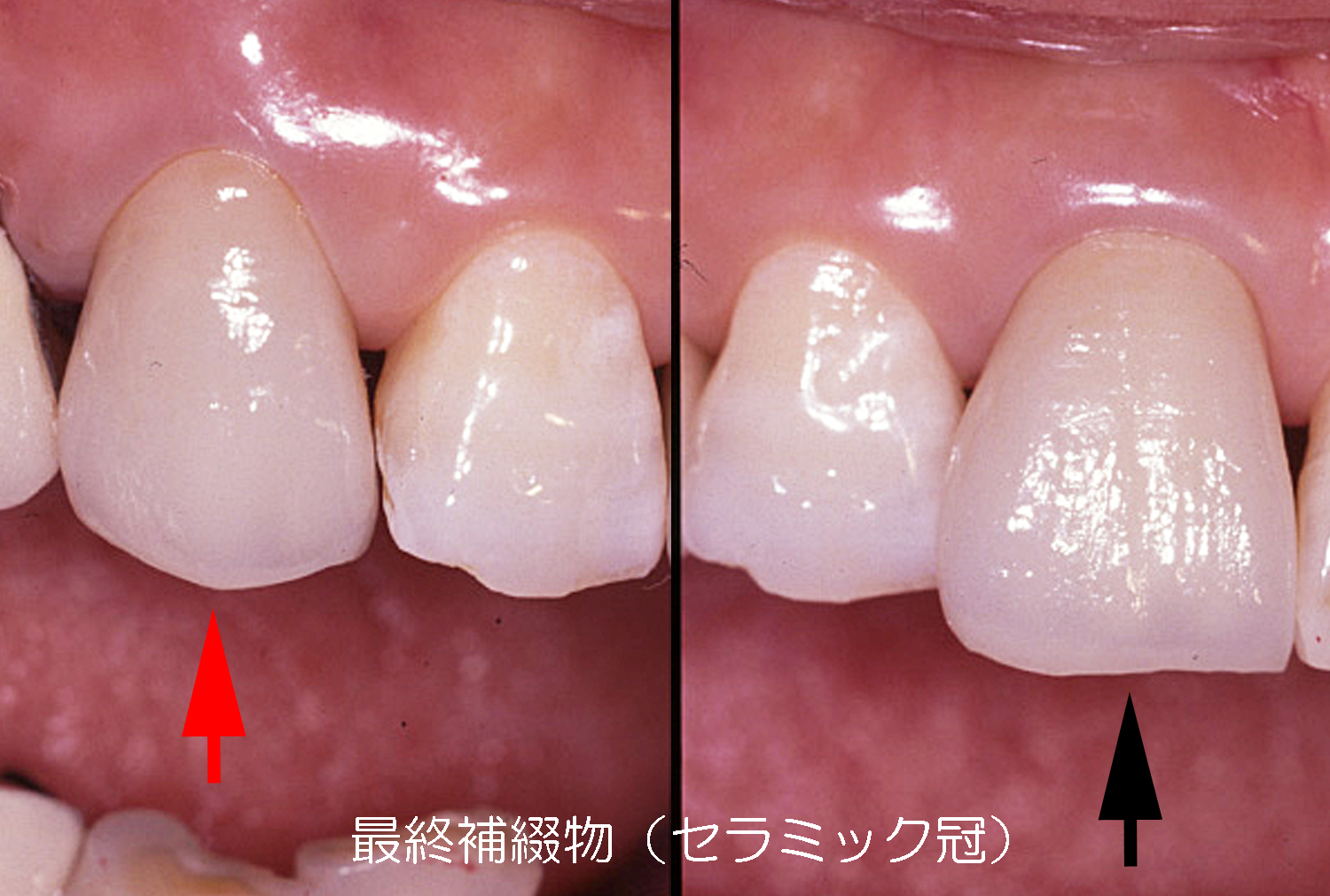歯冠修復（審美歯科）症例2