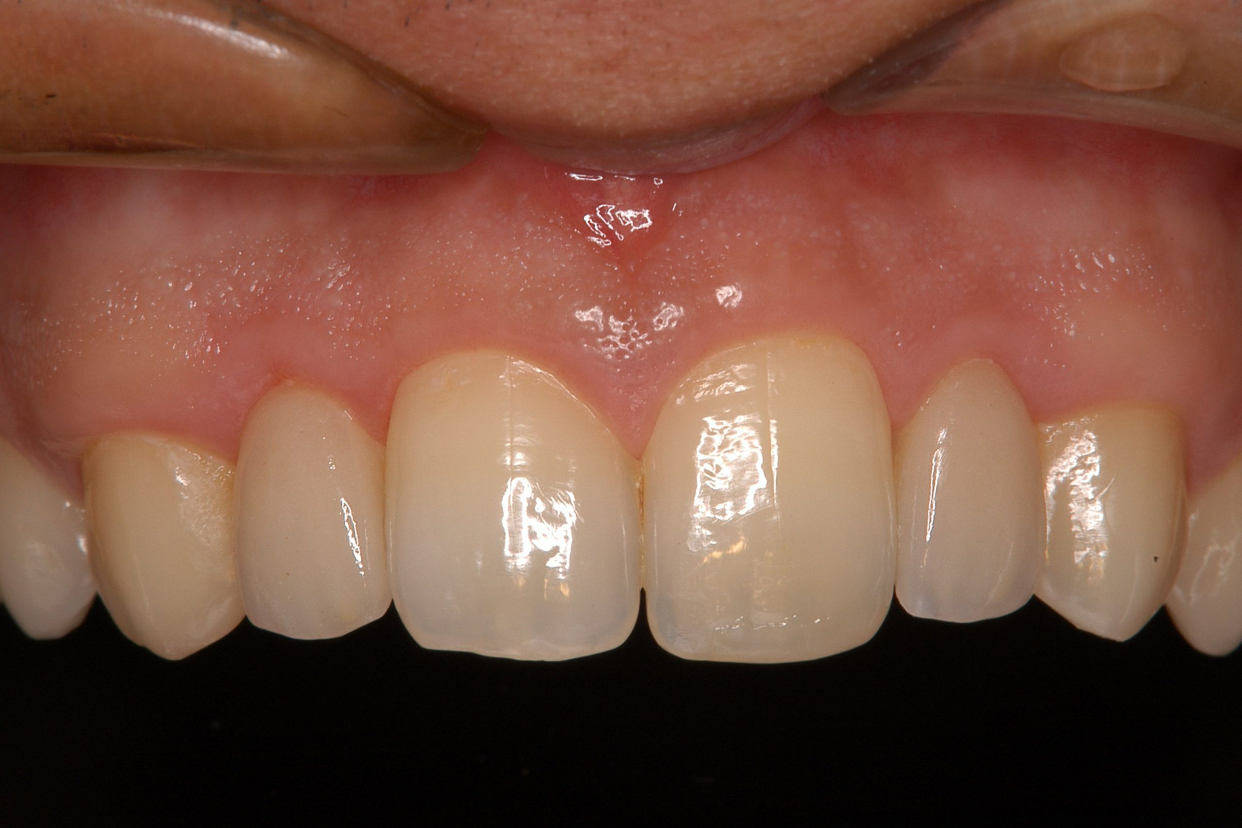 歯冠修復（審美歯科）症例20