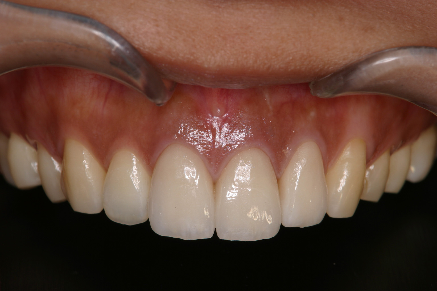 歯冠修復（審美歯科）症例22