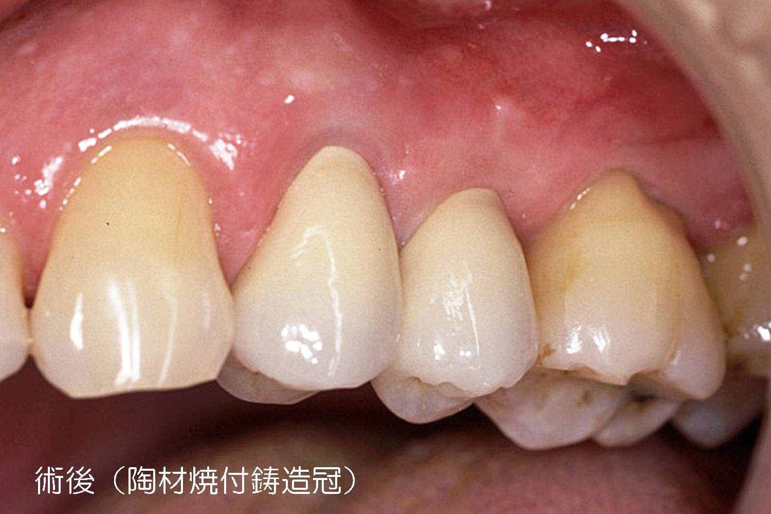歯冠修復（審美歯科）症例3