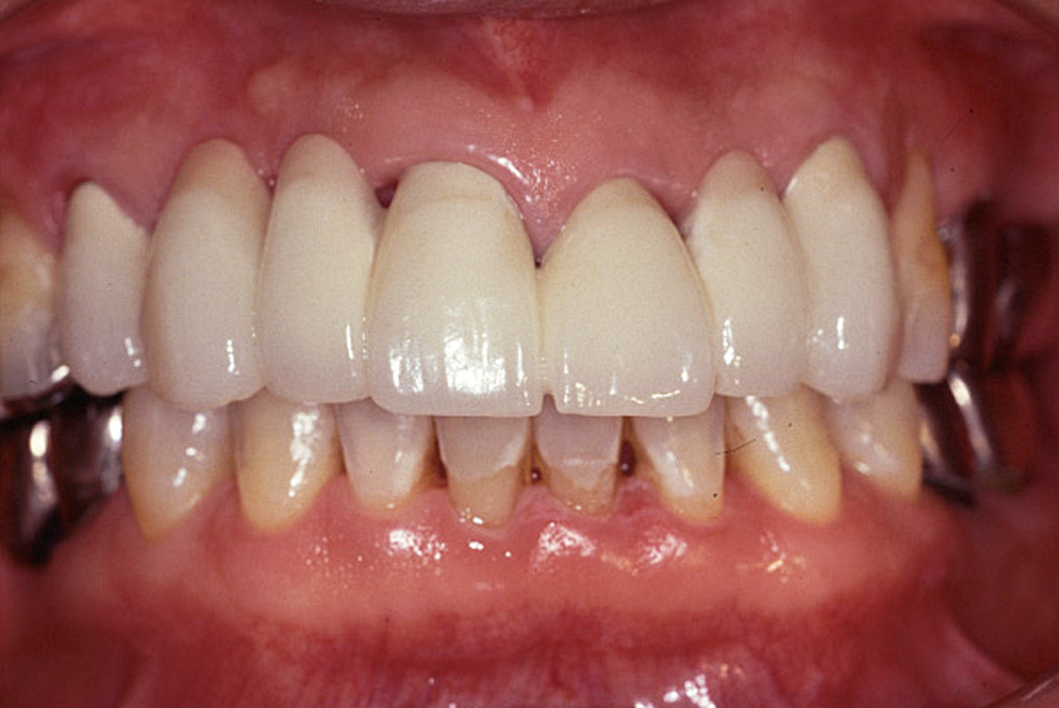 歯冠修復（審美歯科）症例5