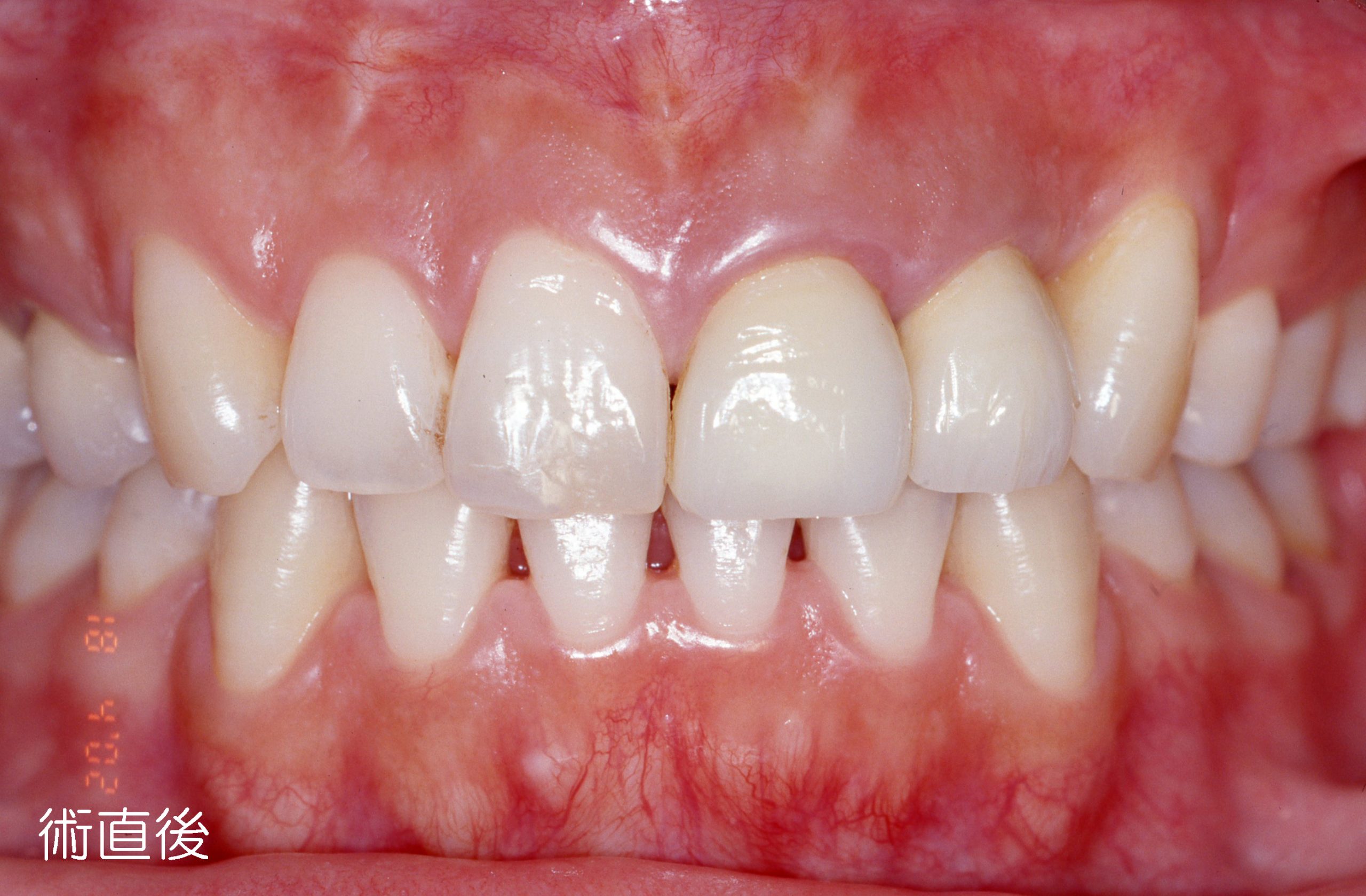 歯冠修復（審美歯科）症例6