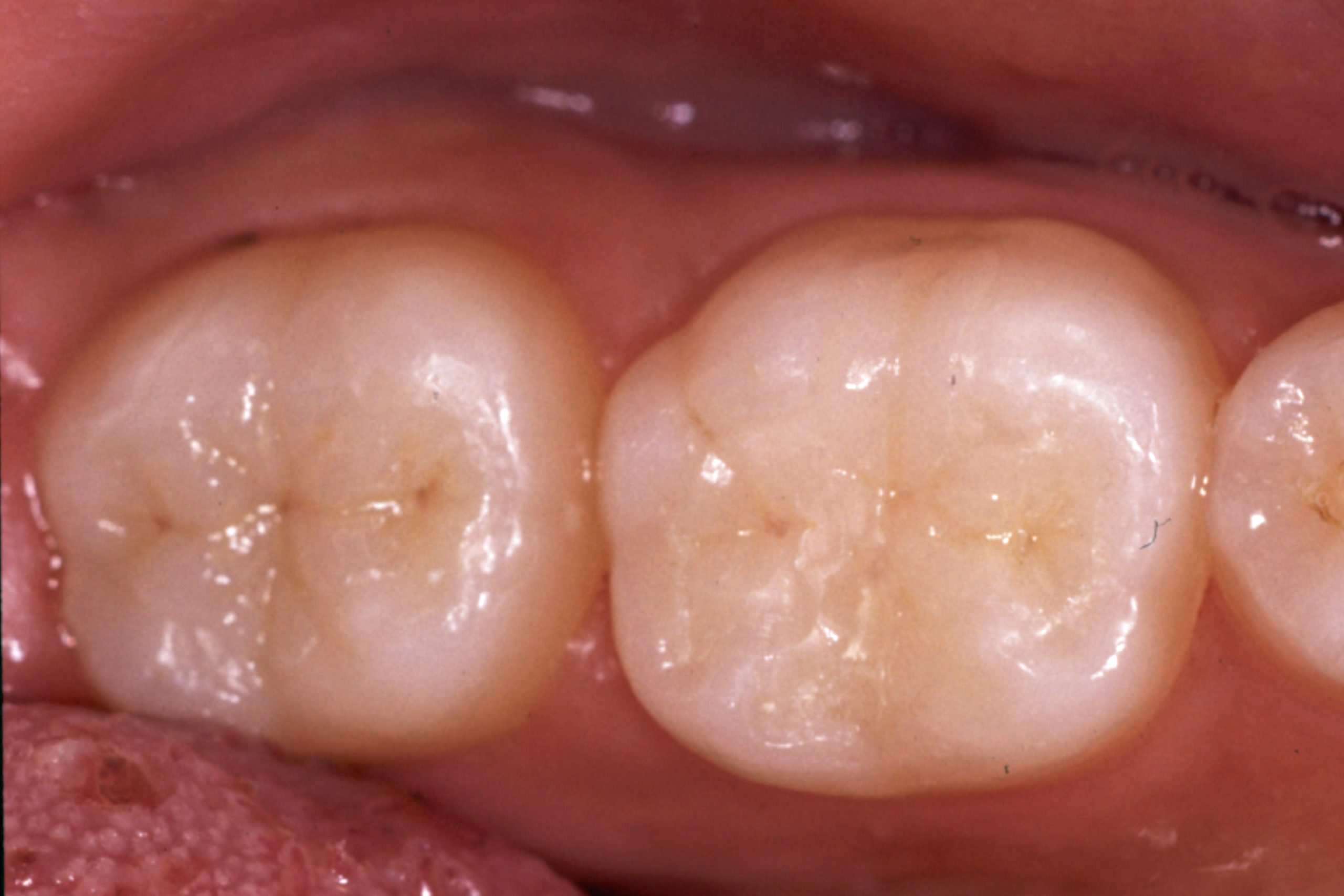 歯冠修復（審美歯科）症例8