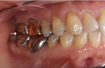 歯冠修復症例15