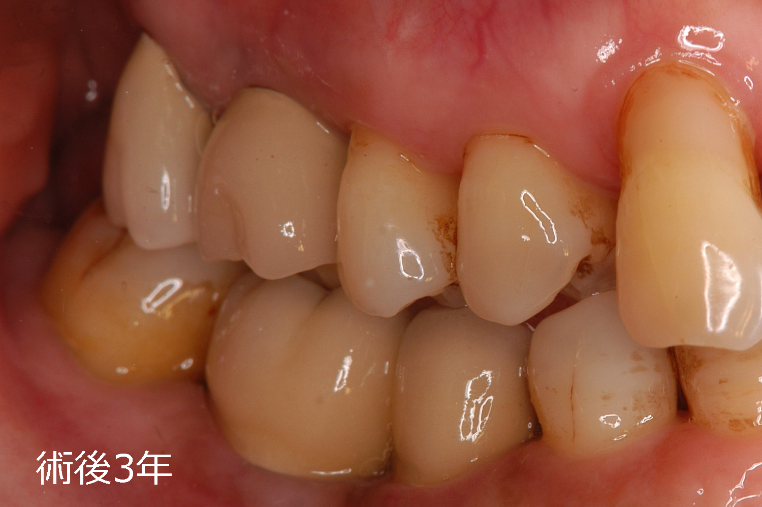インプラント症例22