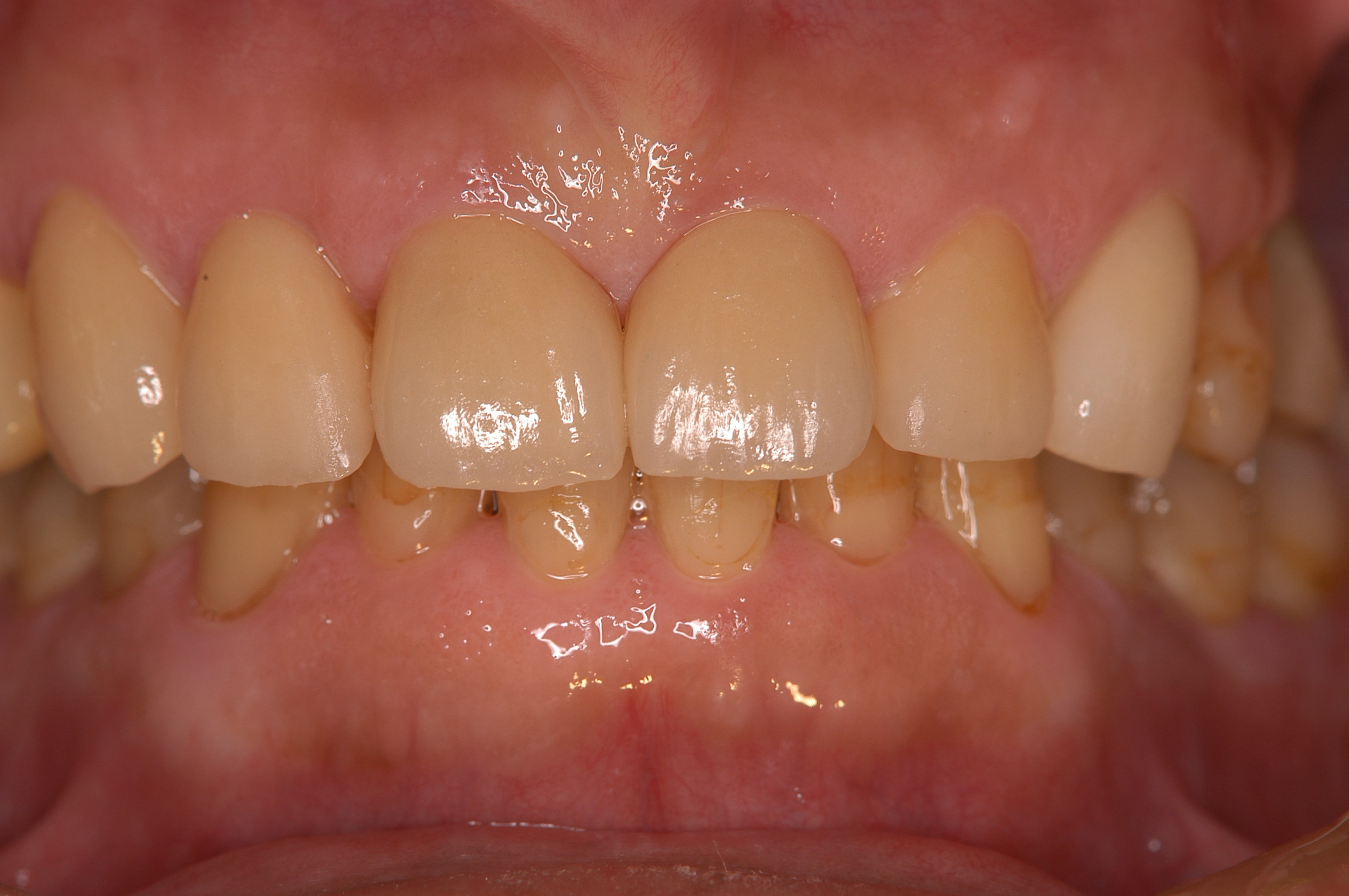 歯冠修復（審美歯科）症例23