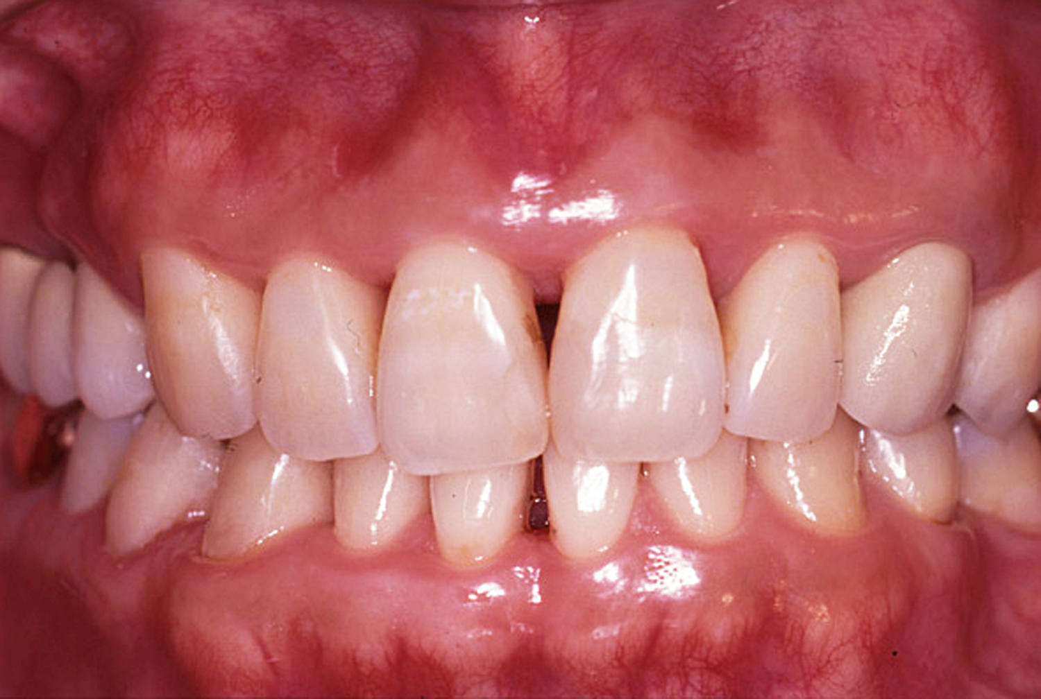 歯周治療症例1