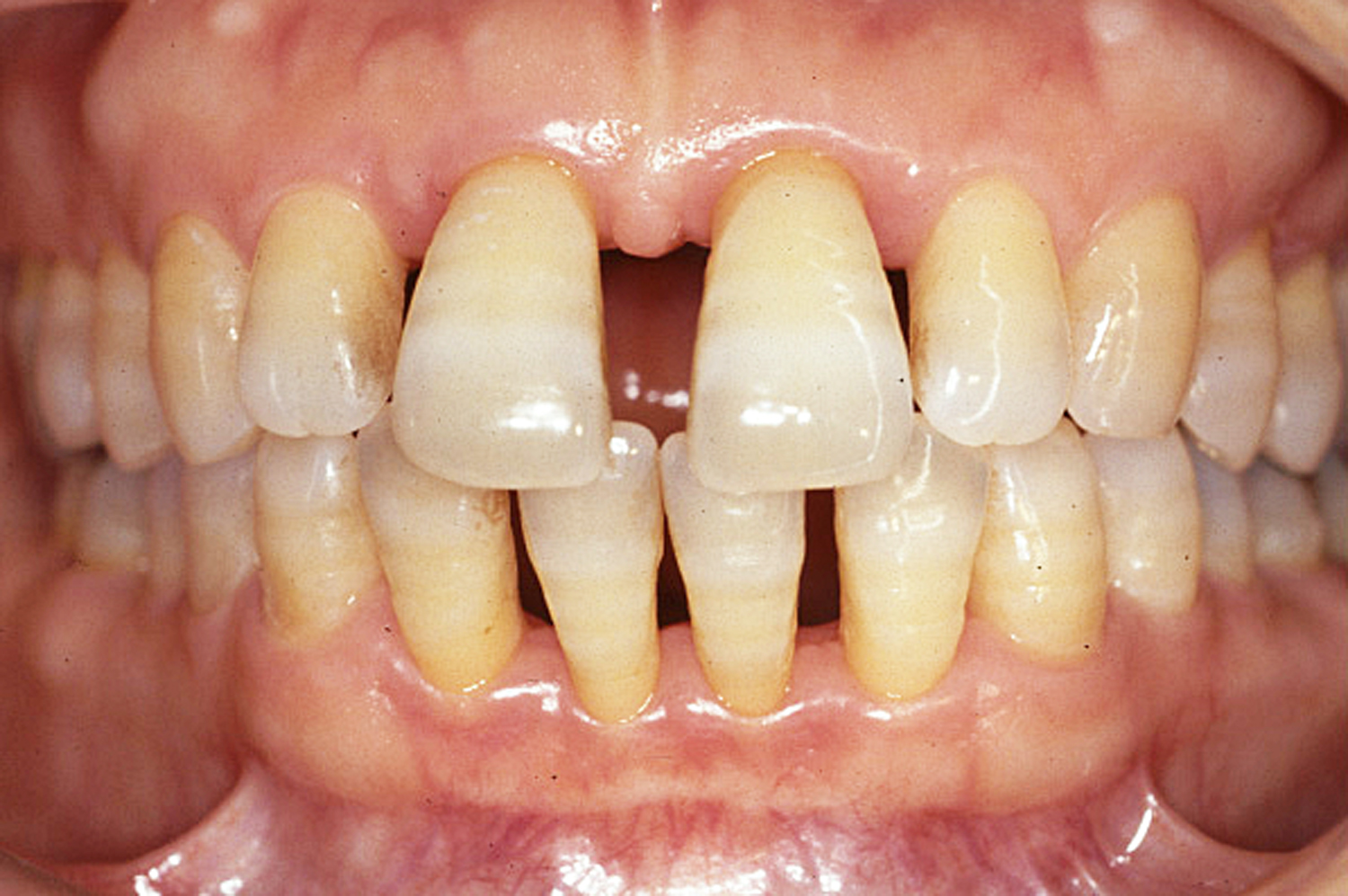 歯周治療症例2