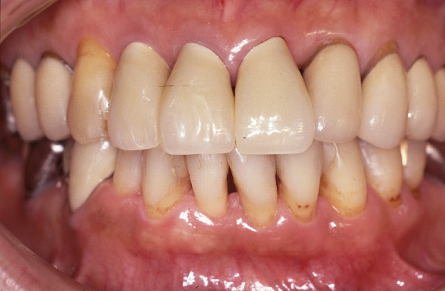 歯周治療症例3