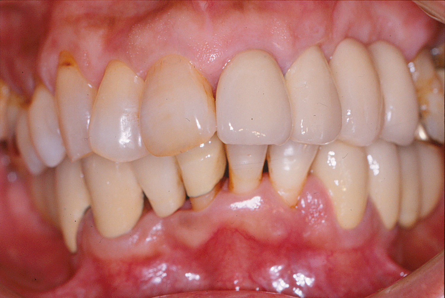 歯周治療症例4