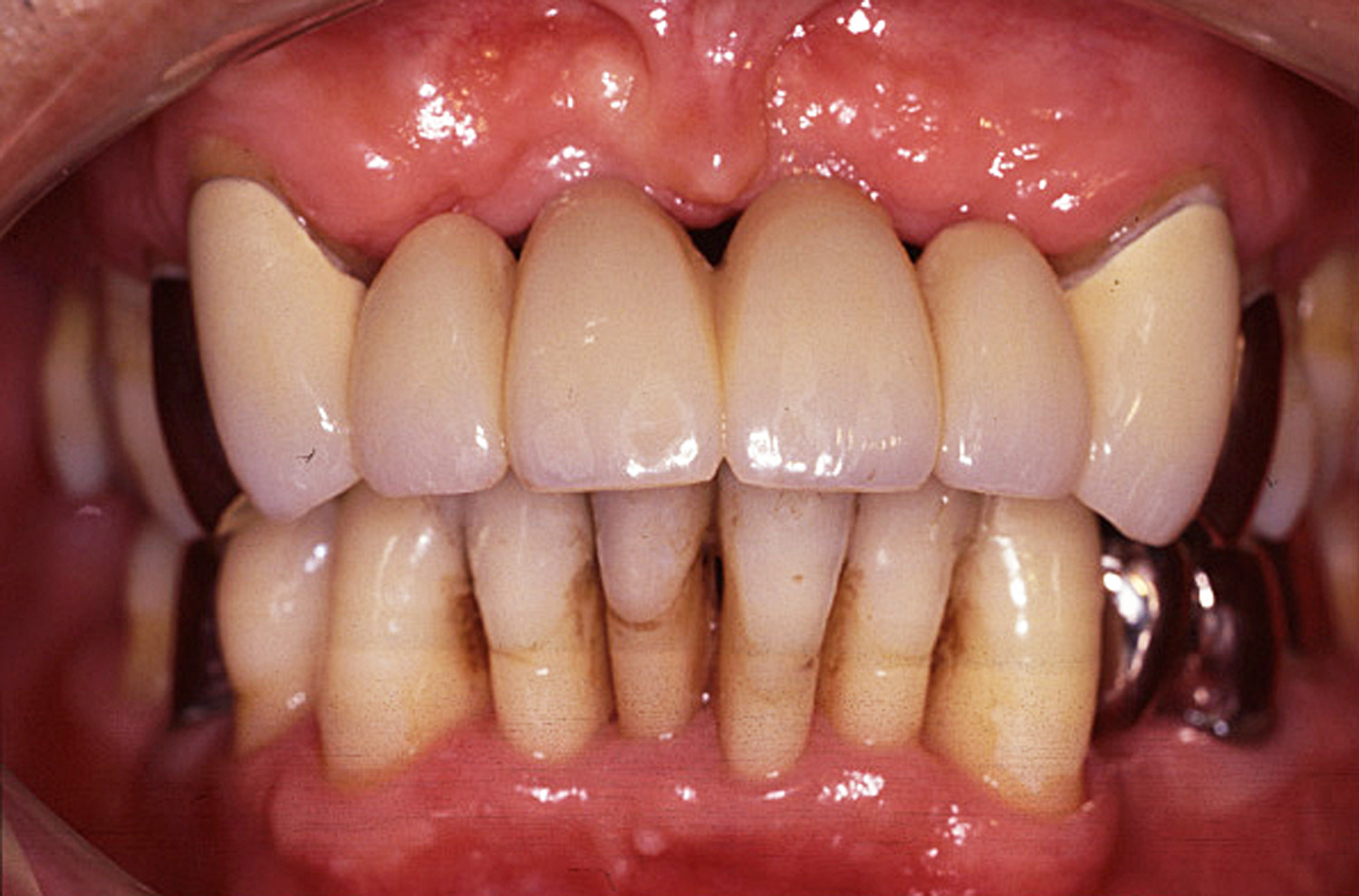 歯周治療症例6