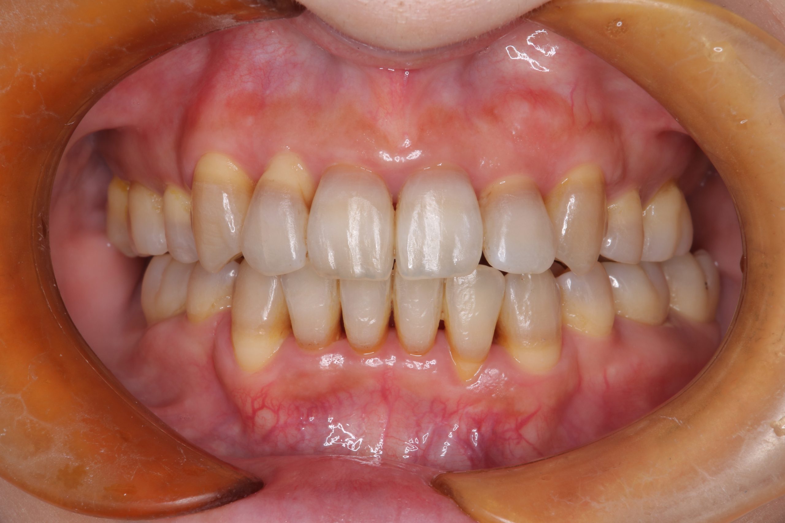 歯周治療症例8