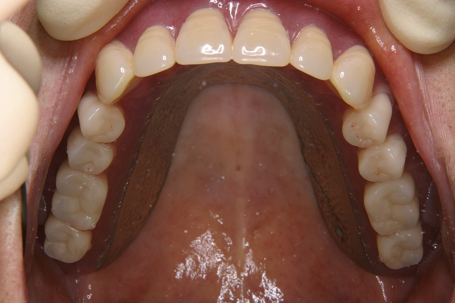 特殊義歯症例4