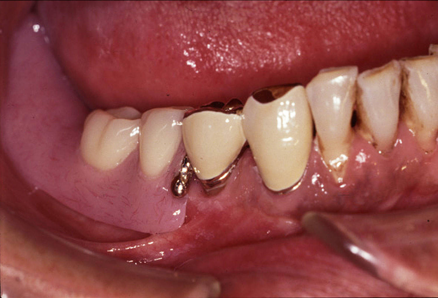 特殊義歯症例1