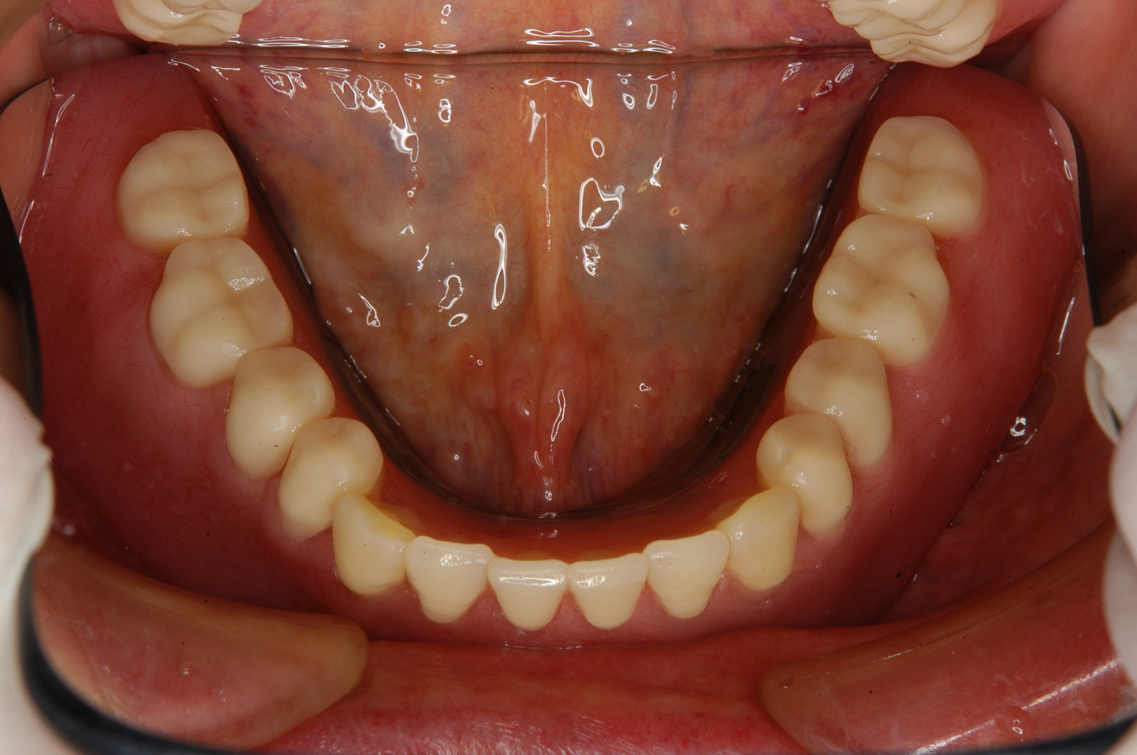 特殊義歯症例2