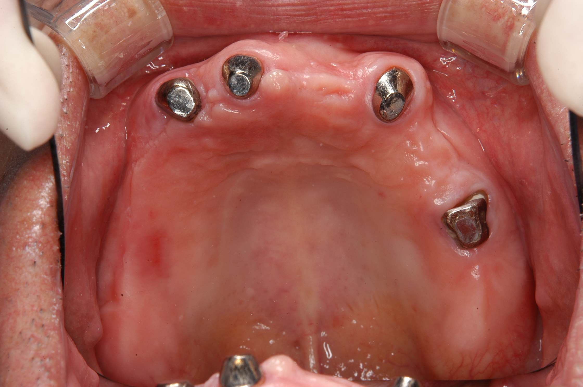 特殊義歯症例3