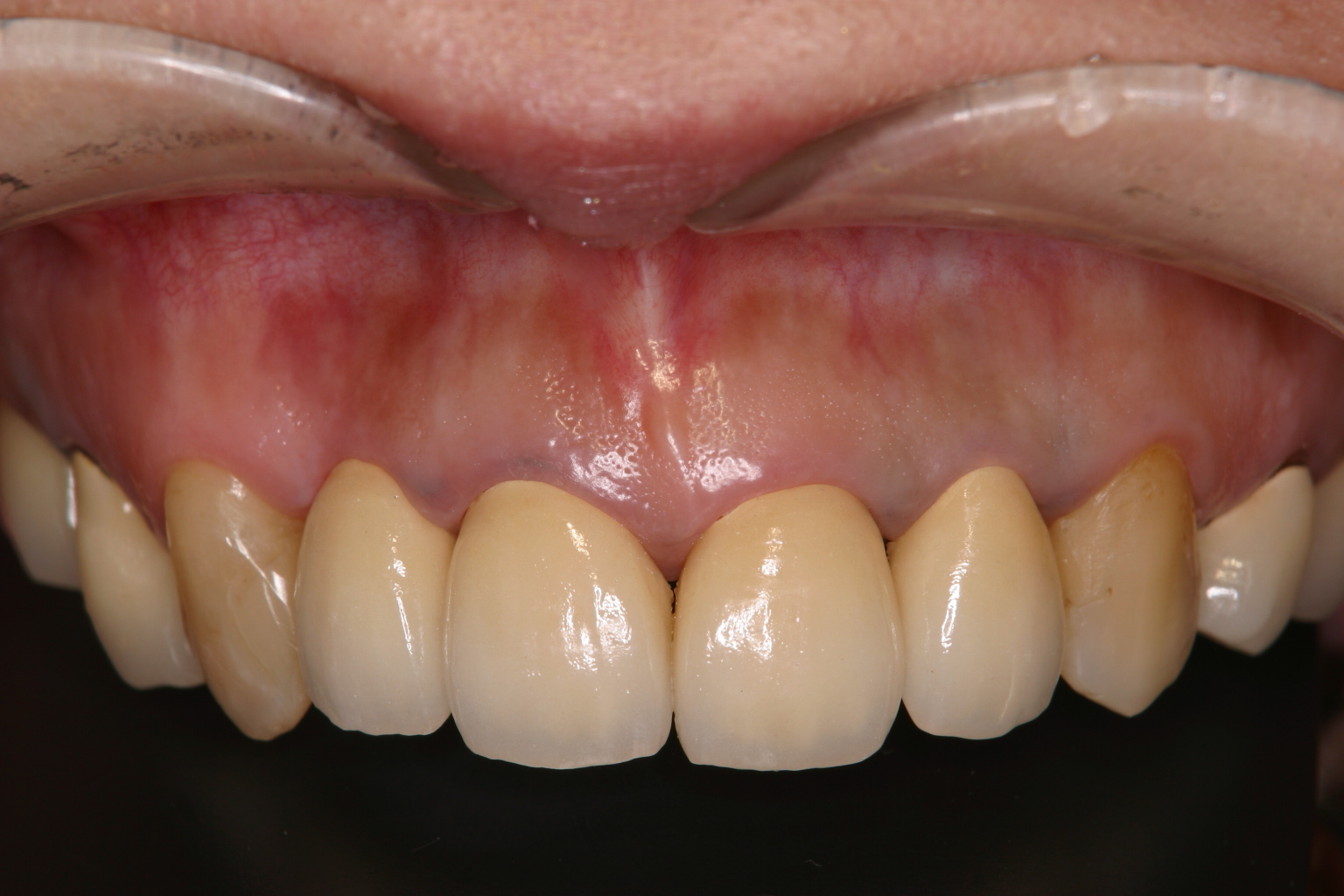 歯冠修復（審美歯科）症例29