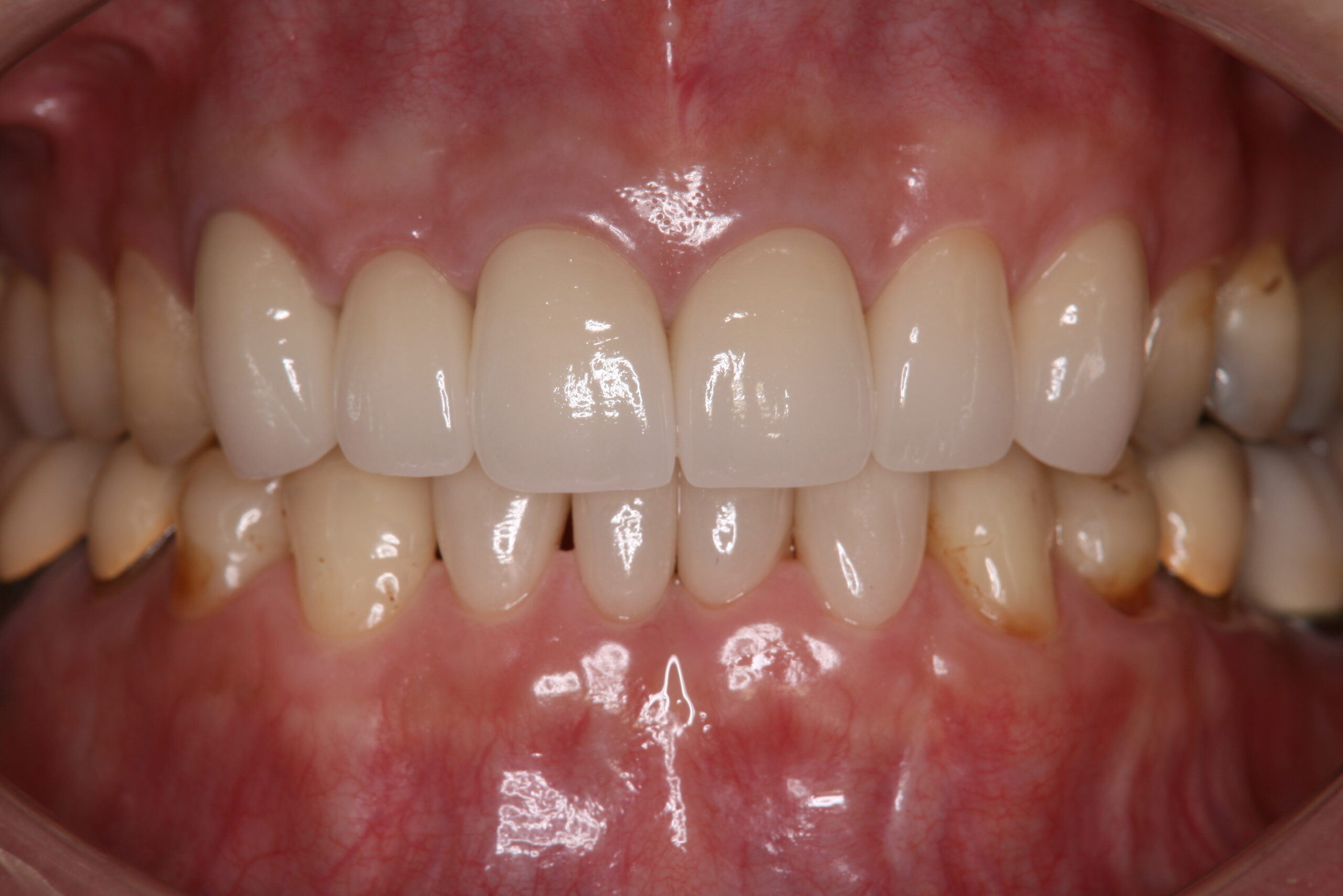 歯冠修復（審美歯科）症例32