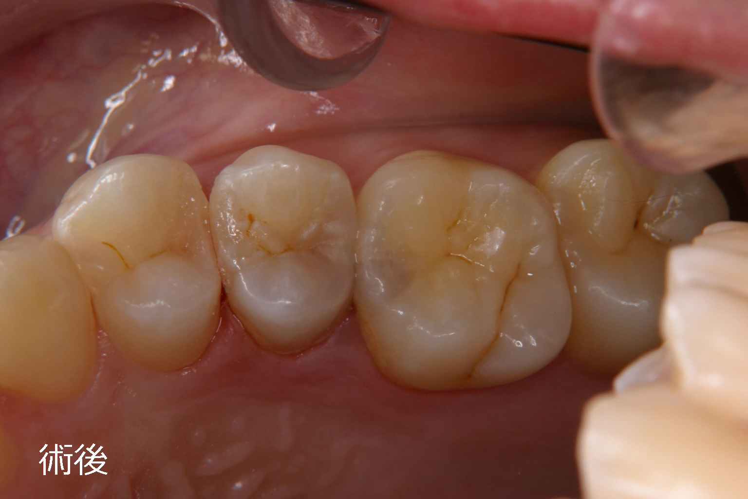 歯冠修復（う蝕治療）症例30