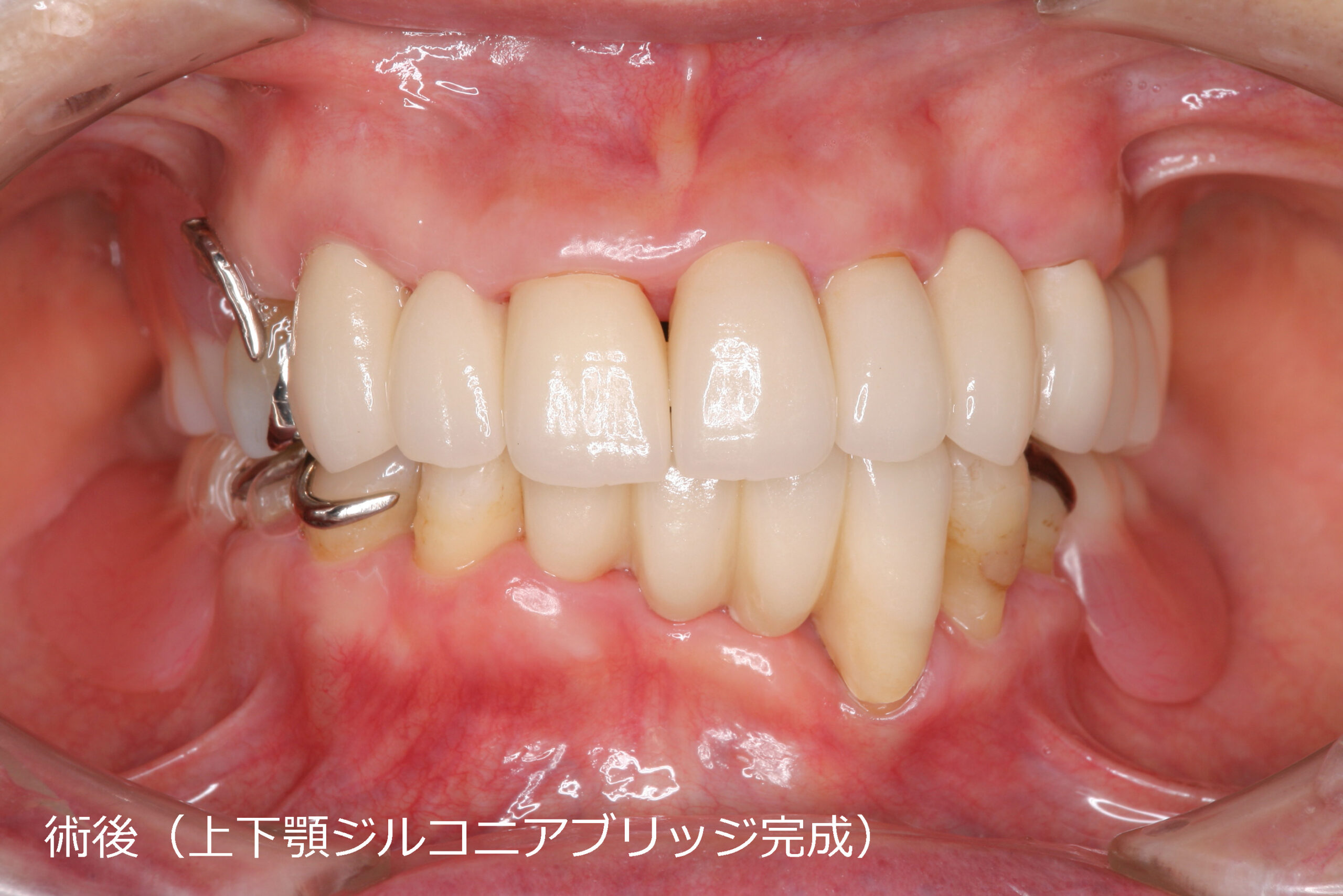 歯冠修復（審美歯科）症例31
